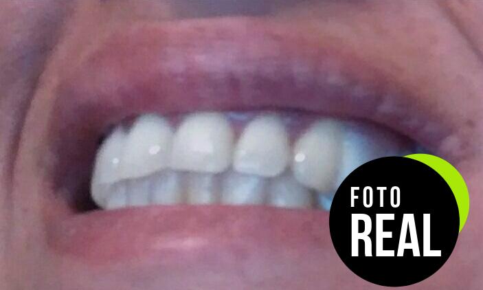 creadent-kit-diente-cosmetico-blanco-foto-3